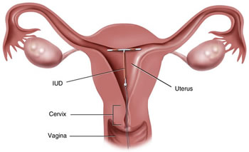 Iud side effects insertion after IUD Side